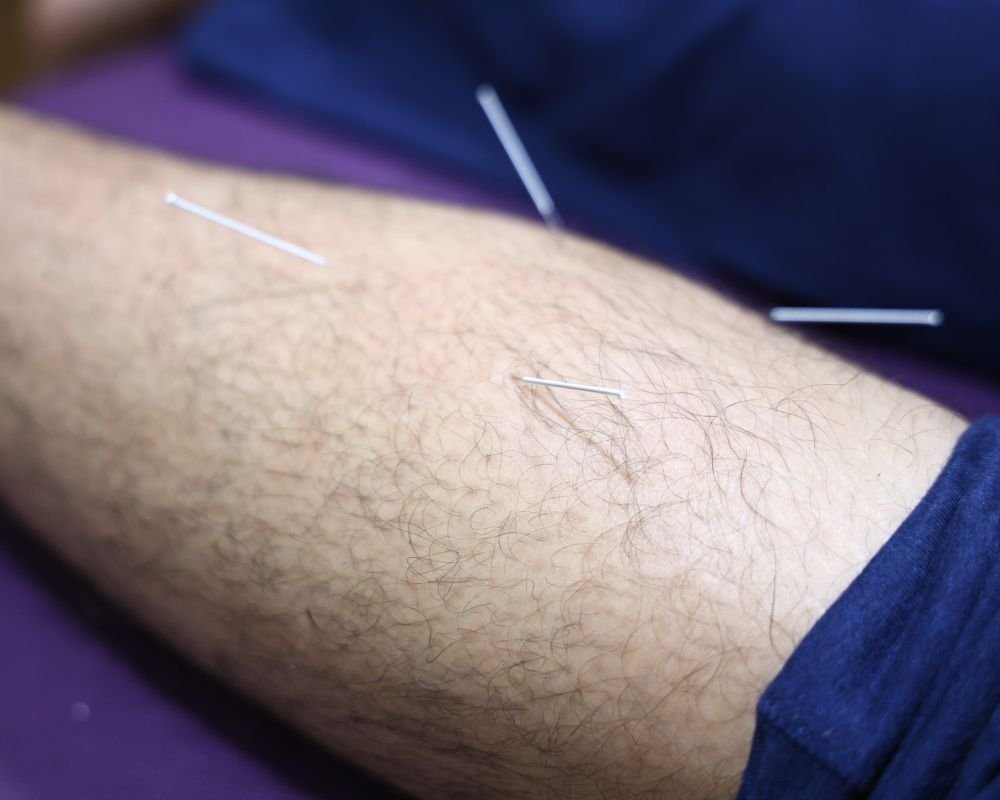 What is Advanced Dry Needling Therapy?